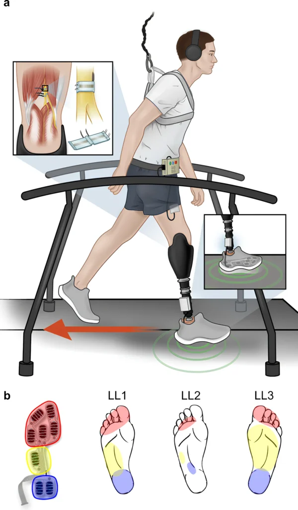 Сенсорный нейропротез ноги