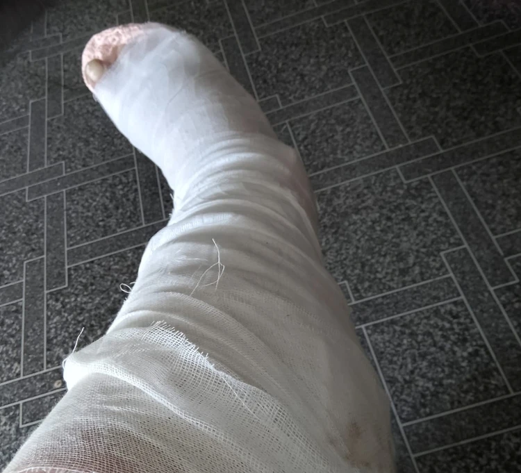 Юле наложили гипс